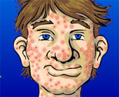 Acne Be Gone